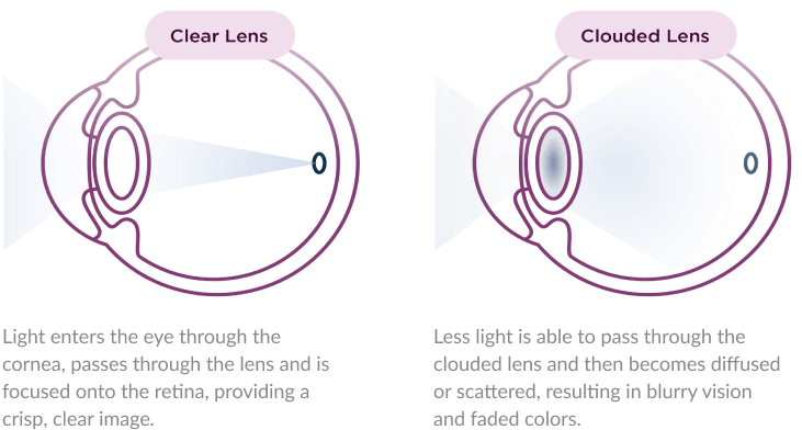 Comparison of a clear lens and a cloudy lens, highlighting the clarity difference in visual quality and light transmission