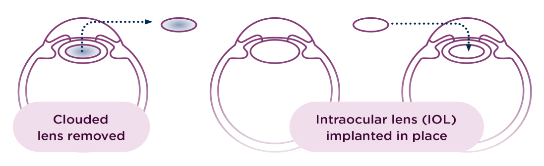 A diagram illustrating various types of lenses, including convex, concave, and cylindrical, with labeled features