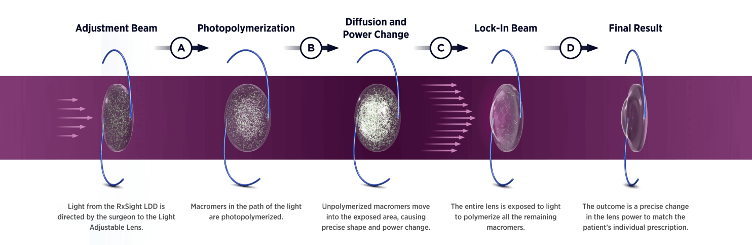 Illustration depicting how light adjustable lens work