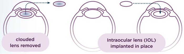 Diagram illustrating the structure of the lens and lens capsule in the human eye, highlighting their anatomical features